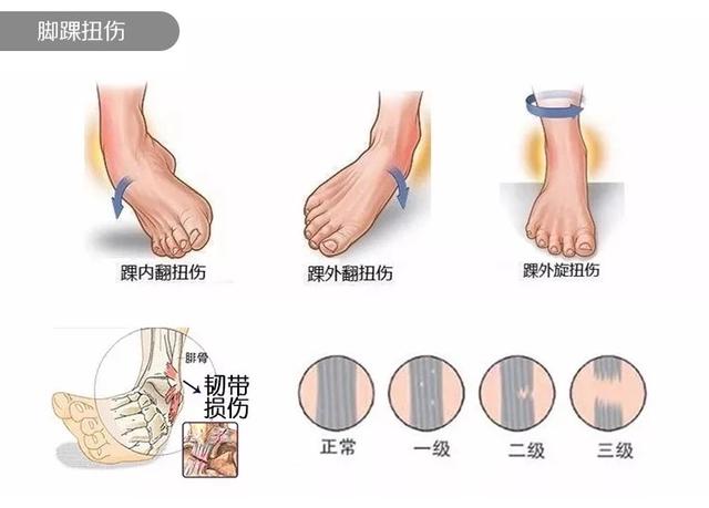 东契奇崴脚看看缺席的这段时间他都会做哪些康复